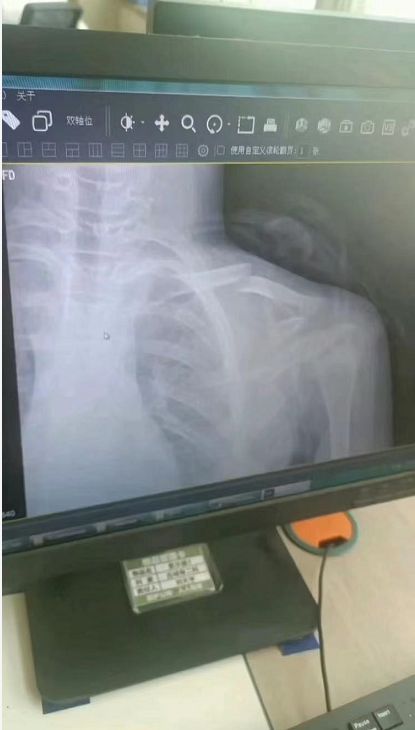 WilliamHill山东小学生跳绳慢被体育老师踹断锁骨报警4个月仅被停职处理(图1)